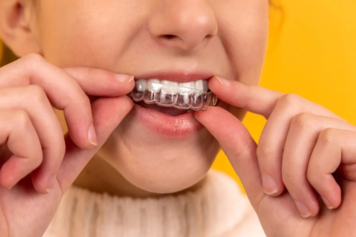 Clear aligner being fitted